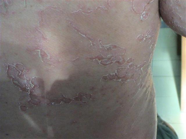 GENODERMATOSES - Netherton syndrome GENODERMATOSES - Netherton syndrome