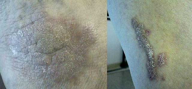 LICHEN - Hypertrophic lichen planus LICHEN - Hypertrophic lichen planus