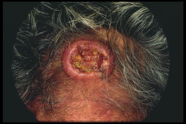 LYMPHOMAS - LYMPHOCYTIC INFILTRATIONS - Mycosis Fungoides LYMPHOMAS - LYMPHOCYTIC INFILTRATIONS - Mycosis Fungoides