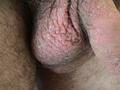 PSORIASIS - Psoriasis of the Genitalia