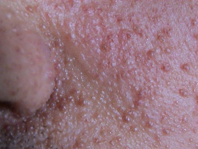 GENODERMATOSES - Tuberous sclerosis complex (Bourneville's disease), adenomata seborrheic