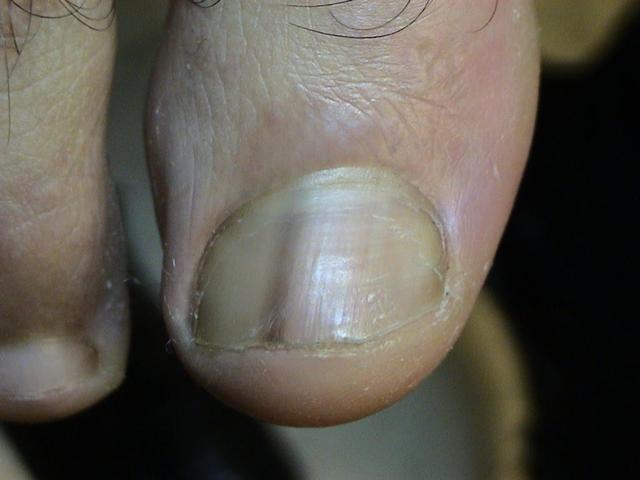 NAIL DISEASES - Melanonychia longitudinal NAIL DISEASES - Melanonychia longitudinal