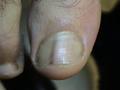 NAIL DISEASES - Melanonychia longitudinal