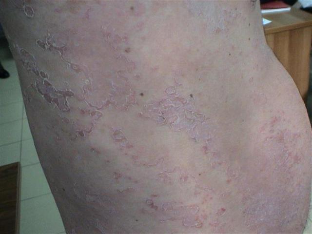 GENODERMATOSES - Netherton syndrome