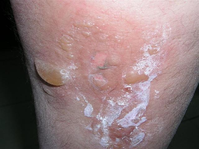 FACTICIAL LESIONS - Ice Burn FACTICIAL LESIONS - Ice Burn