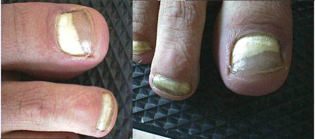 SUPERFICIAL FUNGAL INFECTIONS - Proximal subungual onychomycosis