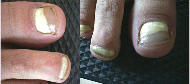 SUPERFICIAL FUNGAL INFECTIONS - Proximal subungual onychomycosis SUPERFICIAL FUNGAL INFECTIONS - Proximal subungual onychomycosis