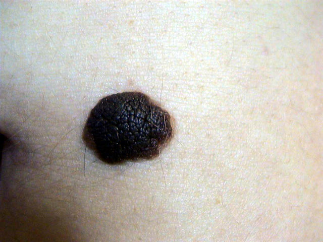 Nevus - definition of nevus by The Free Dictionary