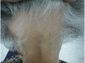 HAIR DISEASES - Alopecia Areata