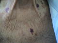 DRUG ERUPTIONS - Ecchymoses due to topical corticosteroids