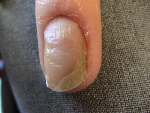 NAIL DISEASES - Onychomycosis NAIL DISEASES - Onychomycosis