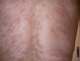 VARIOUS or of UNKNOWN ETIOLOGY DISEASES - Pityriasis rosea