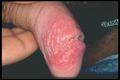 VIRAL INFECTIONS - Genital Herpes