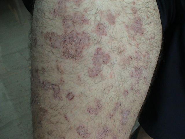 DERMATITIS - EKZEMA - Infected eczema DERMATITIS - EKZEMA - Infected eczema