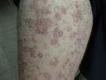 DERMATITIS - EKZEMA - Infected eczema