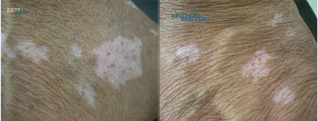 PIGMENTATION DISORDERS - Vitiligo