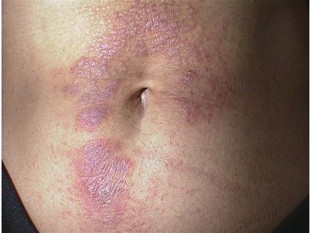 DERMATITIS - EKZEMA - Allergic Contact Dermatitis DERMATITIS - EKZEMA - Allergic Contact Dermatitis