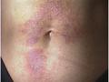 DERMATITIS - EKZEMA - Allergic Contact Dermatitis
