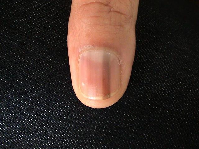 NAIL DISEASES - Melanonychia longitudinal