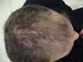 HAIR DISEASES - Androgenetic alopecia