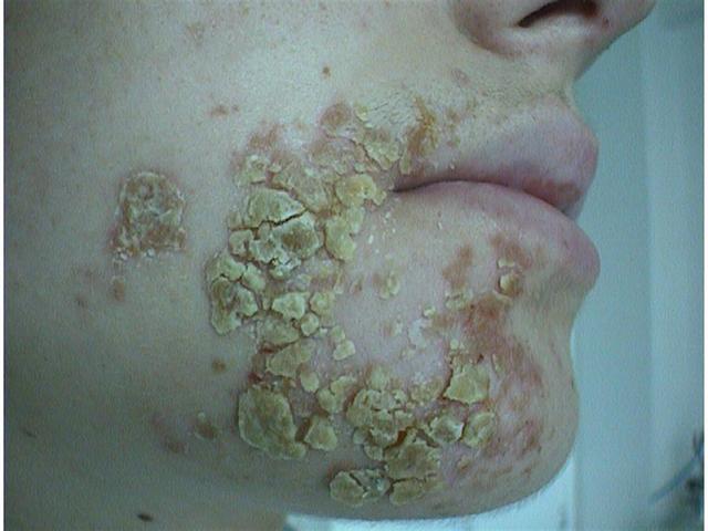 BACTERIAL INFECTIONS - Impetigo BACTERIAL INFECTIONS - Impetigo