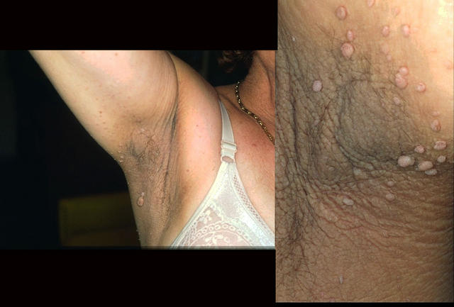 PARANEOPLASTIC DISEASES - Acanthosis nigricans in a patient with stomach cancer