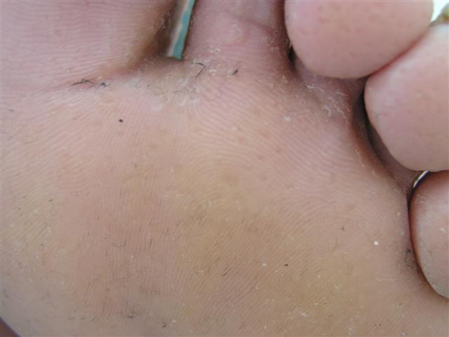 GENODERMATOSES - Acrokeratosis verruciformis of Hopf GENODERMATOSES - Acrokeratosis verruciformis of Hopf