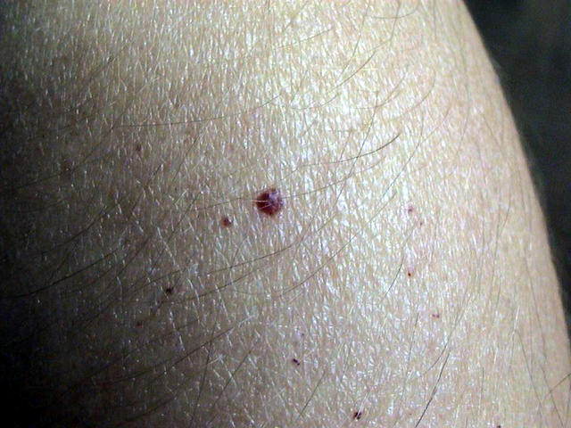 DISEASE OF THE BLOOD AND THE VESSELS – PURPURAS - Campbell de Morgan spots DISEASE OF THE BLOOD AND THE VESSELS – PURPURAS - Campbell de Morgan spots