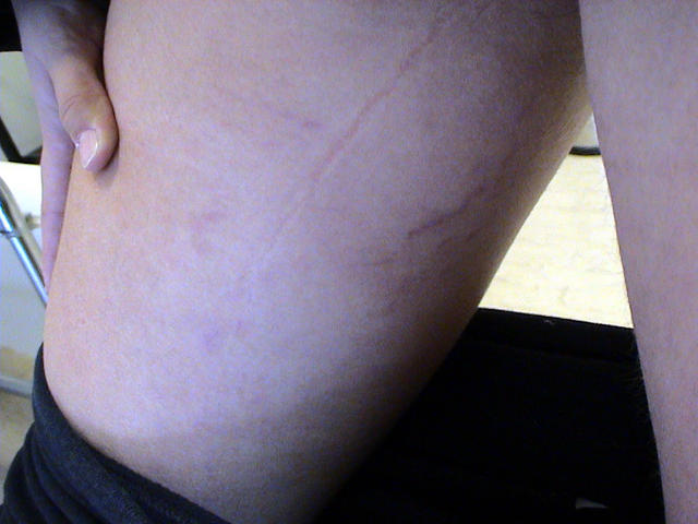 CONNECTIVE TISSUE DISORDERS - Striae CONNECTIVE TISSUE DISORDERS - Striae