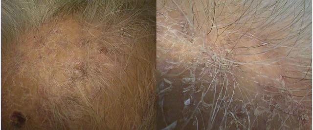 LICHEN - Lichen planopilaris of the scalp LICHEN - Lichen planopilaris of the scalp