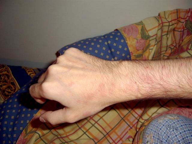 GENODERMATOSES - HIDS Syndrome