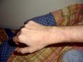 GENODERMATOSES - HIDS Syndrome