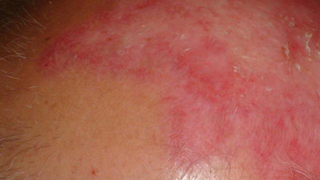 CONNECTIVE TISSUE DISORDERS - Discoid lupus erythematosus