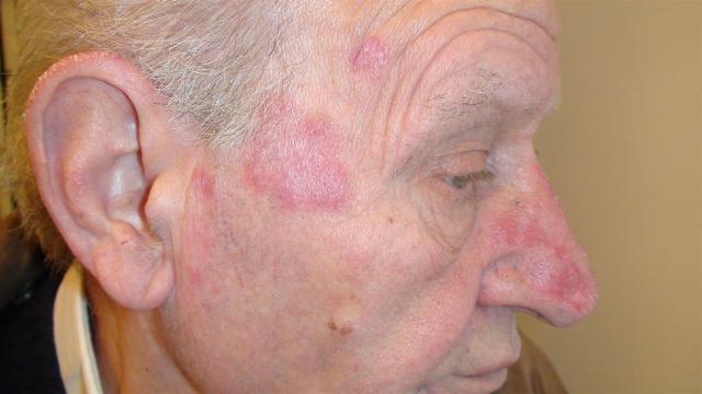 CONNECTIVE TISSUE DISORDERS - Discoid lupus erythematosus