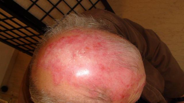 CONNECTIVE TISSUE DISORDERS - Discoid lupus erythematosus