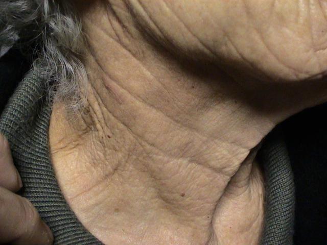 AGEING, PHOTOAGEING - Solar Elastosis, Wrinkles AGEING, PHOTOAGEING - Solar Elastosis, Wrinkles