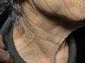AGEING, PHOTOAGEING - Solar Elastosis, Wrinkles