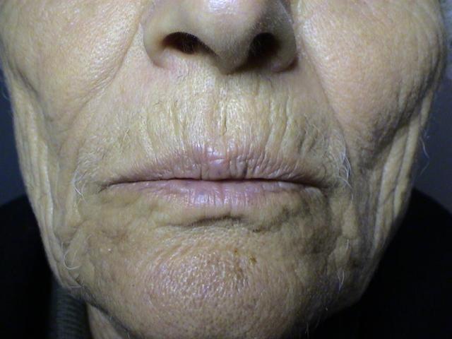 AGEING, PHOTOAGEING - Solar Elastosis, Wrinkles AGEING, PHOTOAGEING - Solar Elastosis, Wrinkles