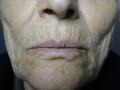 AGEING, PHOTOAGEING - Solar Elastosis, Wrinkles