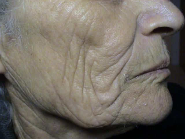 AGEING, PHOTOAGEING - Solar Elastosis, Wrinkles AGEING, PHOTOAGEING - Solar Elastosis, Wrinkles