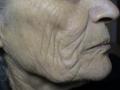 AGEING, PHOTOAGEING - Solar Elastosis, Wrinkles