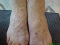 SARCOIDOSIS - Sarcoidosis