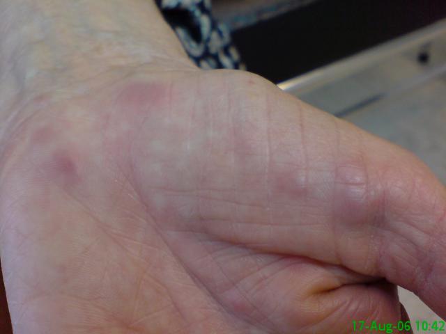 SARCOIDOSIS - Sarcoidosis SARCOIDOSIS - Sarcoidosis
