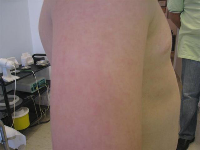 VIRAL INFECTIONS - Erythema Infectiosum VIRAL INFECTIONS - Erythema Infectiosum