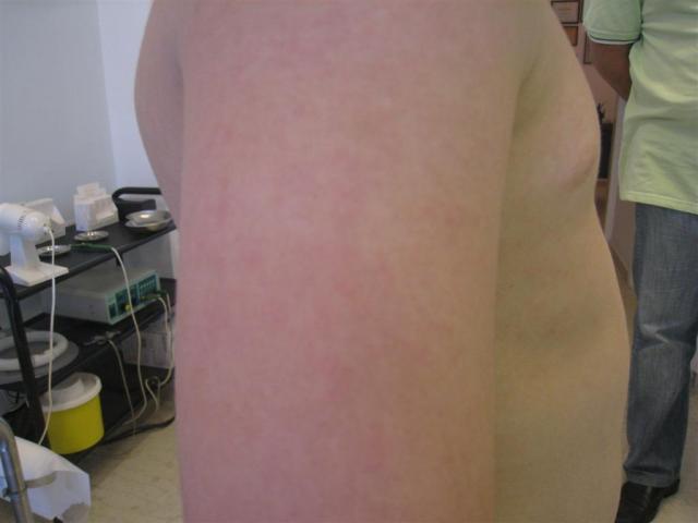 VIRAL INFECTIONS - Erythema Infectiosum