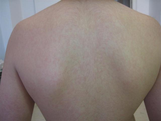 VIRAL INFECTIONS - Erythema Infectiosum VIRAL INFECTIONS - Erythema Infectiosum