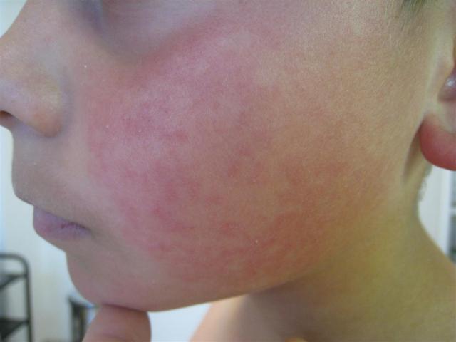 VIRAL INFECTIONS - Erythema Infectiosum VIRAL INFECTIONS - Erythema Infectiosum