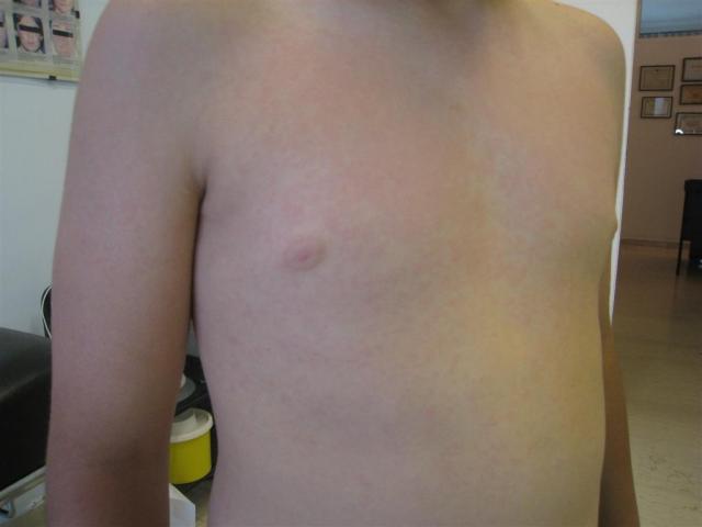VIRAL INFECTIONS - Erythema Infectiosum VIRAL INFECTIONS - Erythema Infectiosum