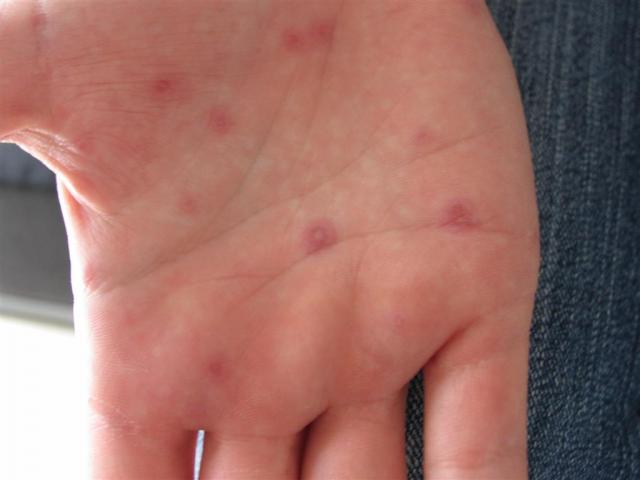 VARIOUS or of UNKNOWN ETIOLOGY DISEASES - Erythema Multiforme VARIOUS or of UNKNOWN ETIOLOGY DISEASES - Erythema Multiforme