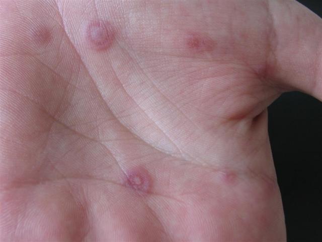 VARIOUS or of UNKNOWN ETIOLOGY DISEASES - Erythema Multiforme